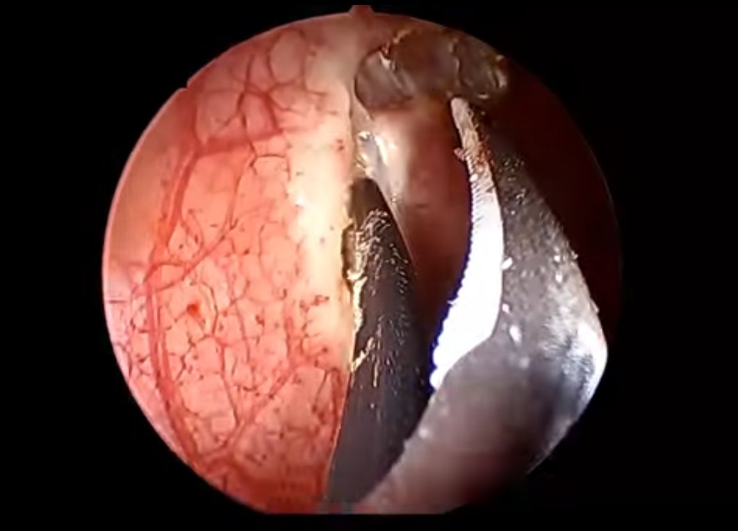 Case Study: Advanced Endoscopic Resection of Smooth Muscle Tumor with Ultrasonic Scalpel